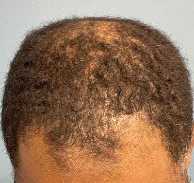 FUE Hair Restoration Before & After Gallery - Patient 631674 - Image 1