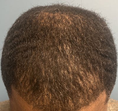 FUE Hair Restoration Before & After Gallery - Patient 631674 - Image 2