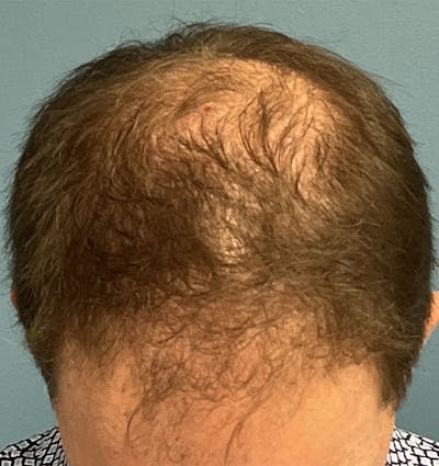 FUE Hair Restoration Before & After Gallery - Patient 335672 - Image 1