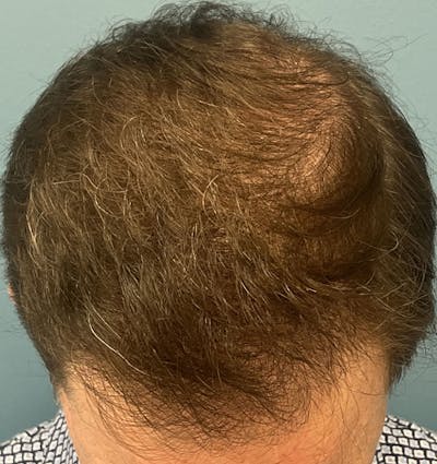 FUE Hair Restoration Before & After Gallery - Patient 335672 - Image 2