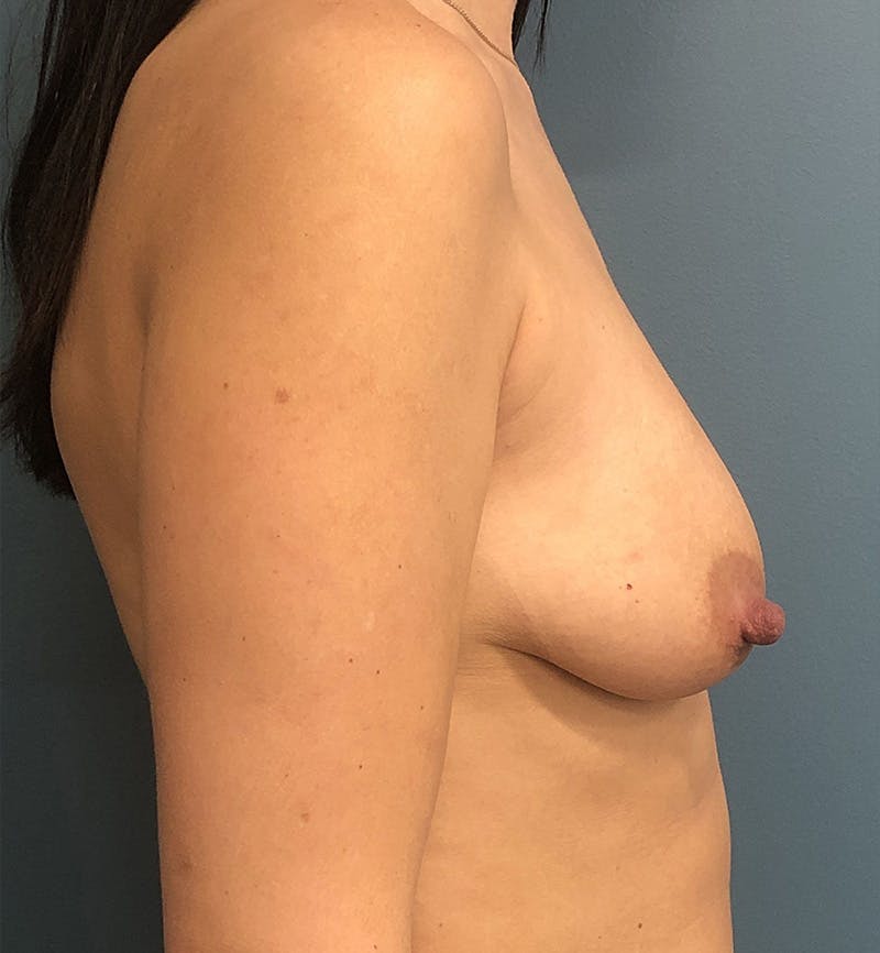 Breast Augmentation with Lift Before & After Gallery - Patient 401914 - Image 3