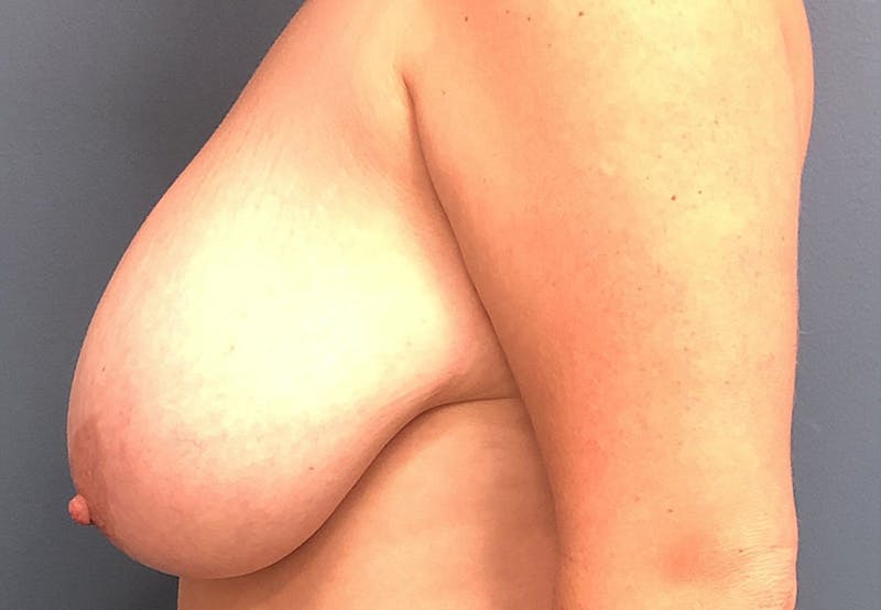 Breast Reduction Before & After Gallery - Patient 337174 - Image 3