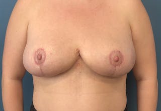 Breast Reduction Before & After Gallery - Patient 337174 - Image 2