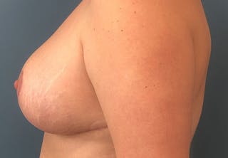 Breast Reduction Before & After Gallery - Patient 337174 - Image 4