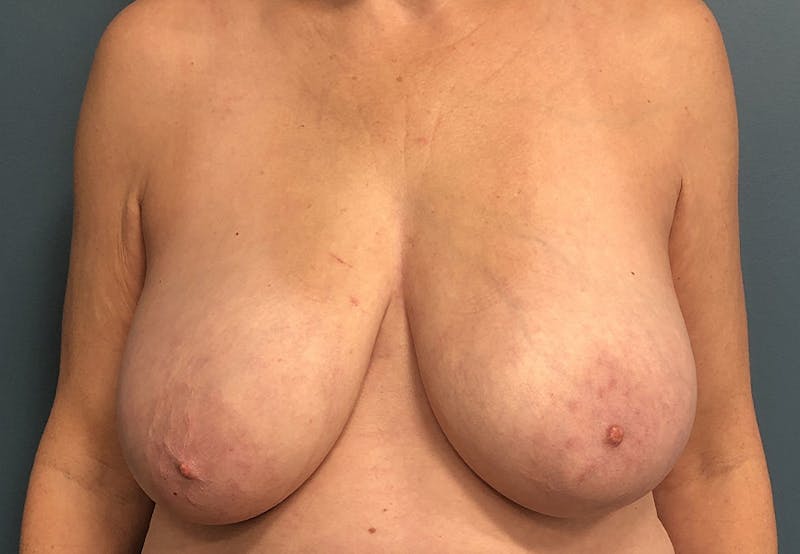 Breast Reduction Before & After Gallery - Patient 264978 - Image 1