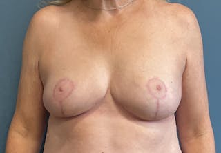 Breast Reduction Before & After Gallery - Patient 264978 - Image 2