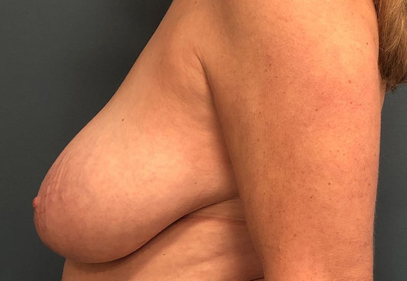 Breast Reduction Before & After Gallery - Patient 264978 - Image 3