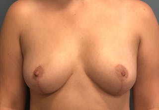 Breast Reduction Before & After Gallery - Patient 386848 - Image 2