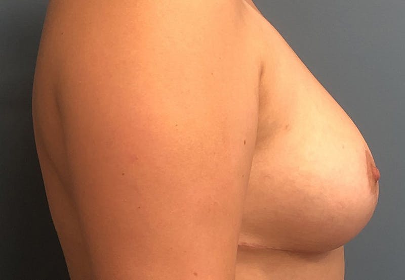 Breast Reduction Before & After Gallery - Patient 386848 - Image 4