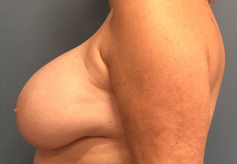 Breast Revision  Before & After Gallery - Patient 383955 - Image 3