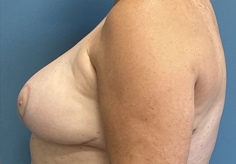 Breast Revision  Before & After Gallery - Patient 383955 - Image 4
