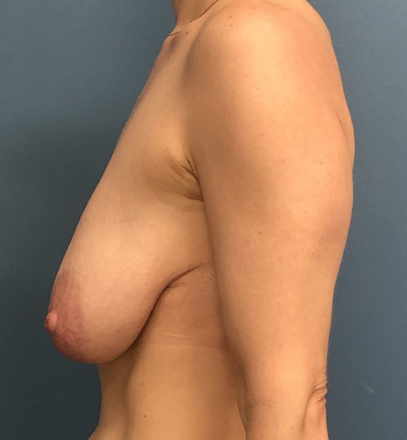 Breast Lift Before & After Gallery - Patient 121669 - Image 3