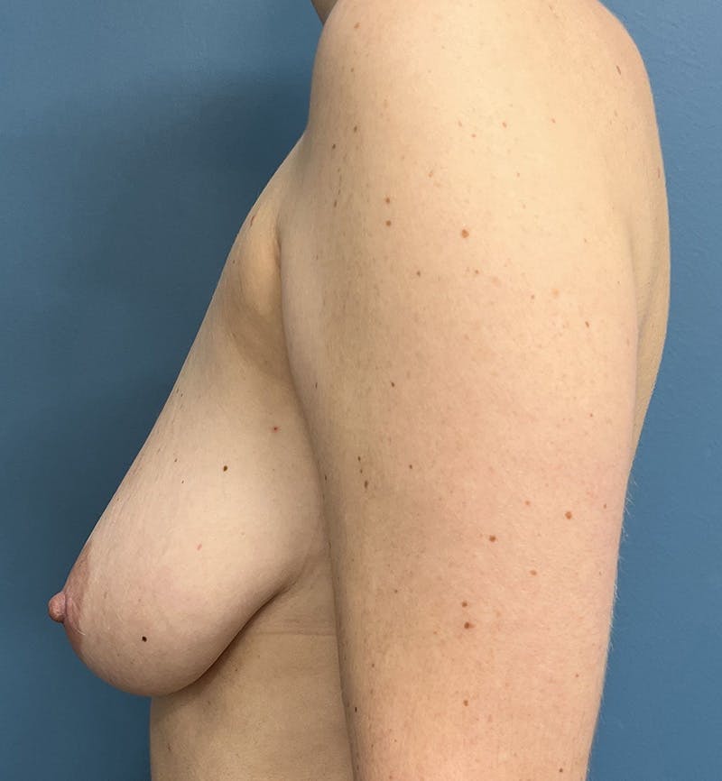 Breast Lift Before & After Gallery - Patient 794738 - Image 3