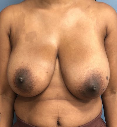 Breast Lift Before & After Gallery - Patient 422143 - Image 1