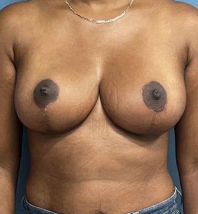 Breast Lift Before & After Gallery - Patient 422143 - Image 2