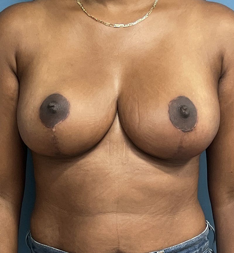Breast Lift Before & After Gallery - Patient 422143 - Image 2