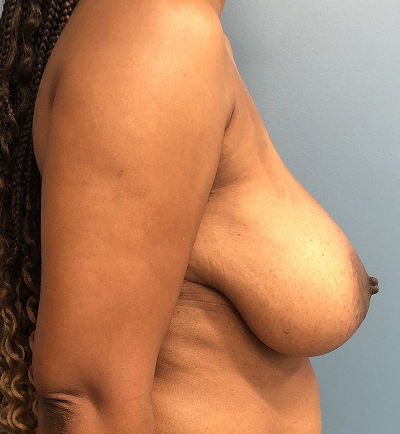 Breast Lift Before & After Gallery - Patient 422143 - Image 3