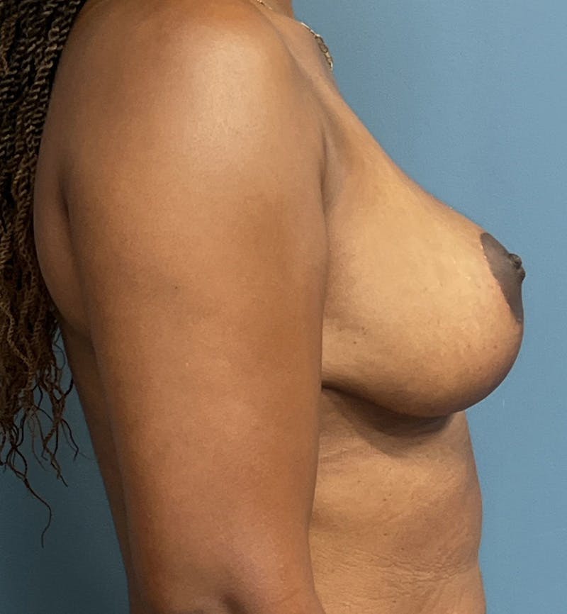 Breast Lift Before & After Gallery - Patient 422143 - Image 4
