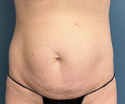 Powertuck Before & After Gallery - Patient 395560 - Image 1