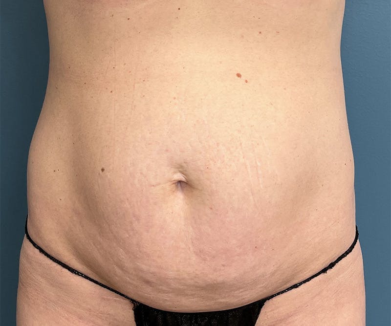 Powertuck Before & After Gallery - Patient 395560 - Image 1