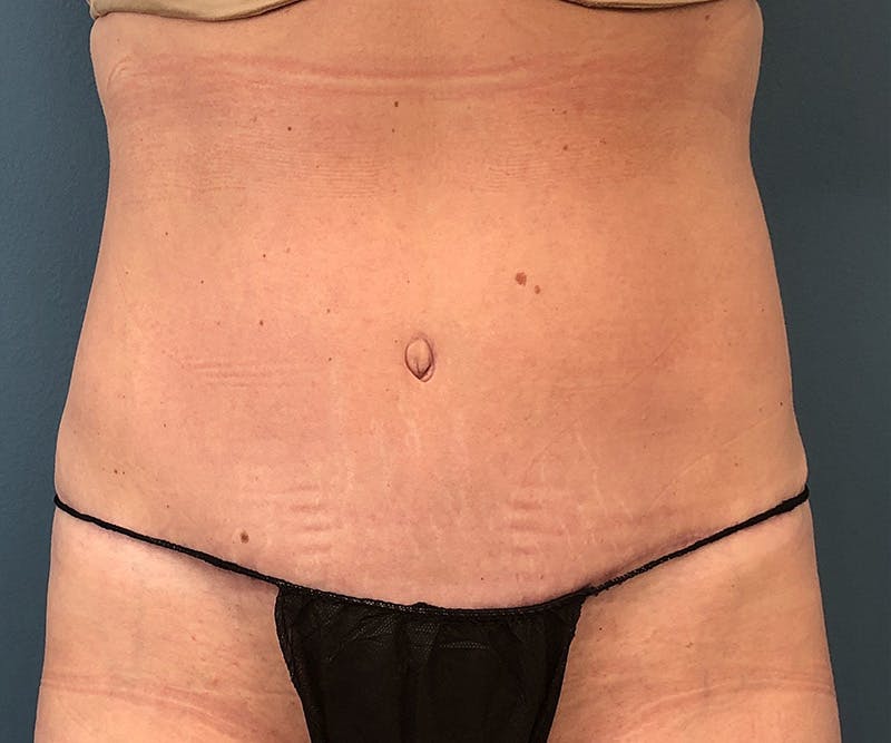 Powertuck Before & After Gallery - Patient 395560 - Image 2
