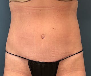 Powertuck Before & After Gallery - Patient 395560 - Image 2
