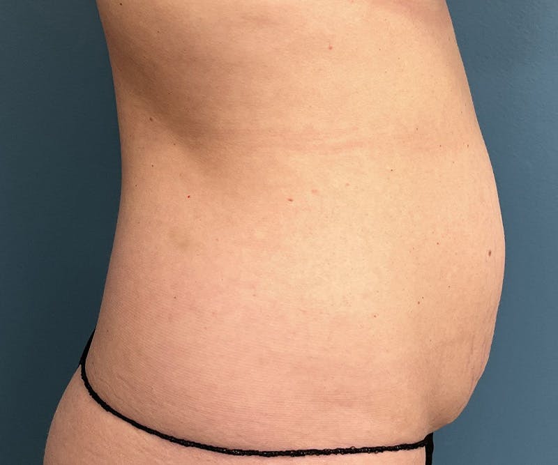 Powertuck Before & After Gallery - Patient 395560 - Image 3