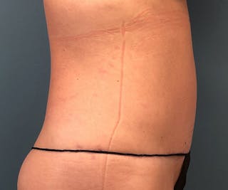 Powertuck Before & After Gallery - Patient 395560 - Image 4