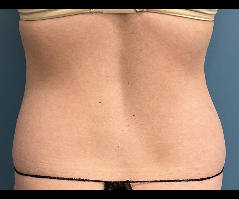 Powertuck Before & After Gallery - Patient 395560 - Image 5