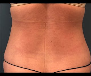 Powertuck Before & After Gallery - Patient 395560 - Image 6