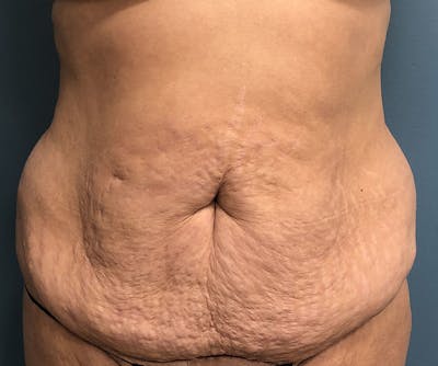 Powertuck Before & After Gallery - Patient 329541 - Image 1
