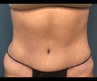 Powertuck Before & After Gallery - Patient 329541 - Image 2