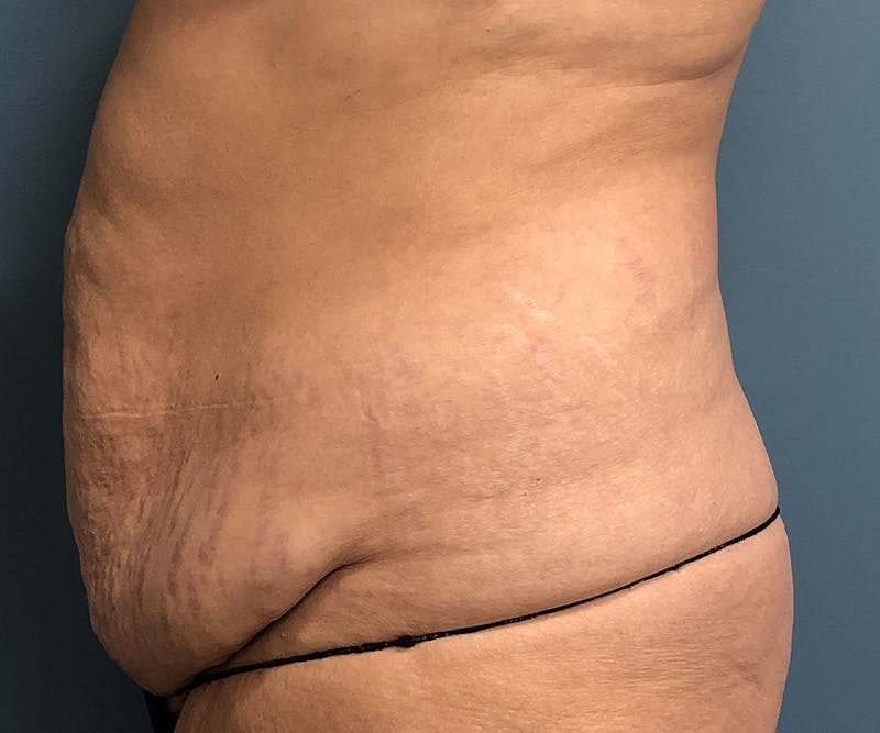 Powertuck Before & After Gallery - Patient 329541 - Image 3