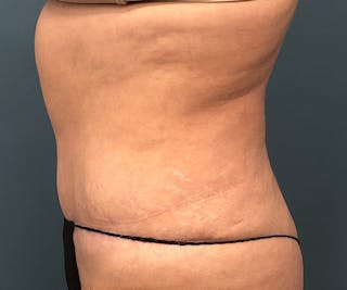 Powertuck Before & After Gallery - Patient 329541 - Image 4