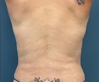 Powertuck Before & After Gallery - Patient 163904 - Image 6