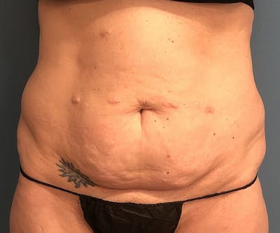 Powertuck Before & After Gallery - Patient 163904 - Image 1