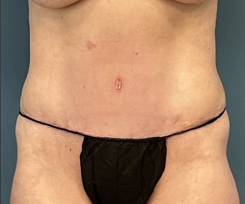 Powertuck Before & After Gallery - Patient 163904 - Image 2