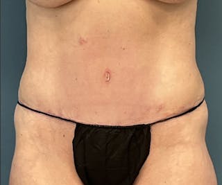 Powertuck Before & After Gallery - Patient 163904 - Image 2