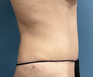 Powertuck Before & After Gallery - Patient 163904 - Image 4