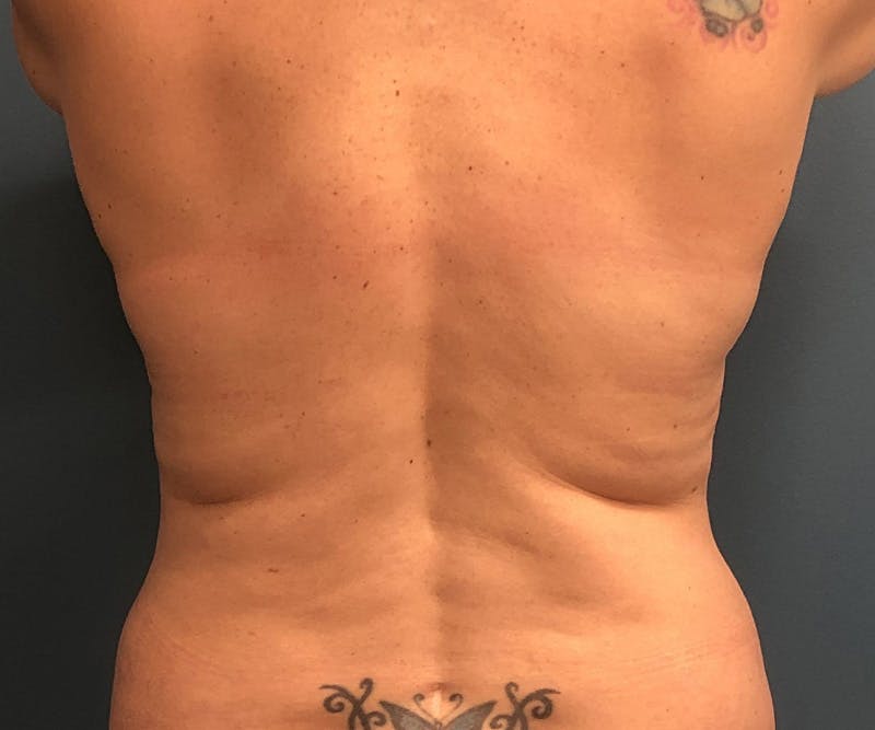 Powertuck Before & After Gallery - Patient 163904 - Image 5