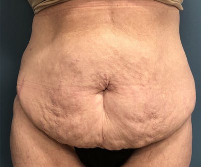 Tummy Tuck Before & After Gallery - Patient 315402 - Image 1