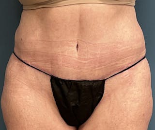 Tummy Tuck Before & After Gallery - Patient 315402 - Image 2