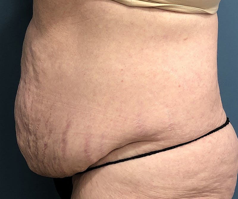 Tummy Tuck Before & After Gallery - Patient 315402 - Image 3