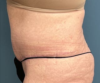 Tummy Tuck Before & After Gallery - Patient 315402 - Image 4