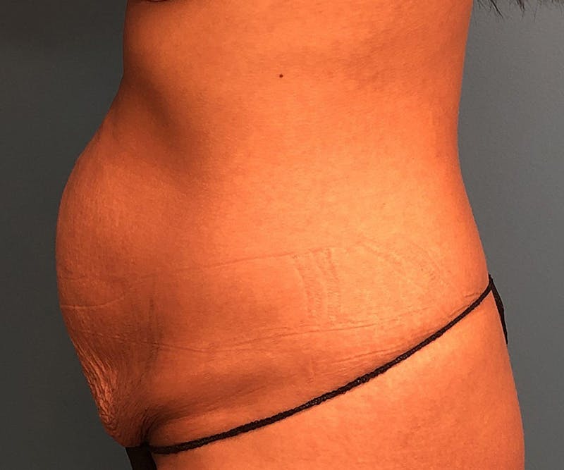 Tummy Tuck Before & After Gallery - Patient 117546 - Image 3