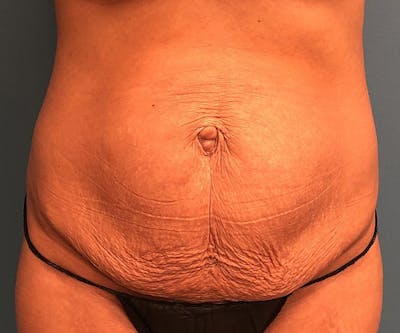 Tummy Tuck Before & After Gallery - Patient 117546 - Image 1