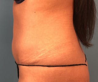 Tummy Tuck Before & After Gallery - Patient 117546 - Image 4