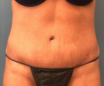 Tummy Tuck Before & After Gallery - Patient 117546 - Image 2