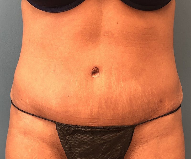 Tummy Tuck Before & After Gallery - Patient 117546 - Image 2