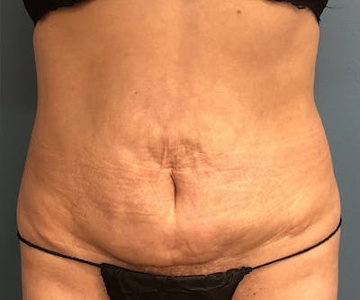 Tummy Tuck Before & After Gallery - Patient 239109 - Image 1